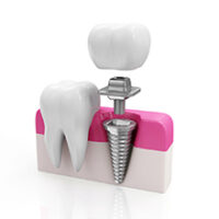 Implantate